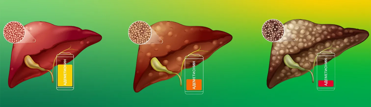 Стадии заболевания печени